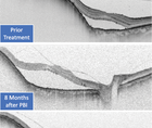 SS OCT Presents Advances in Ocular Tumor Treatment