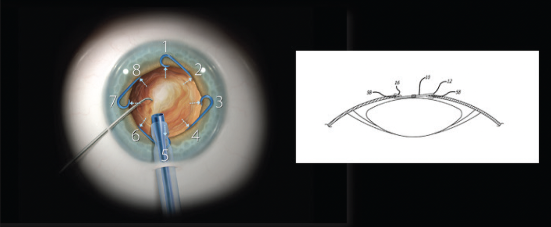 The Development and Impact of the Malyugin Ring