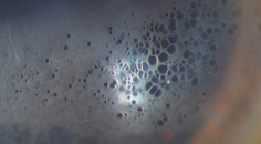 Corneal Changes After IOL Exchange