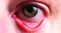 Approaches to Dry Eye Disease