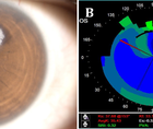 Epithelial Ingrowth After Laser Assisted Lenticule Extraction
