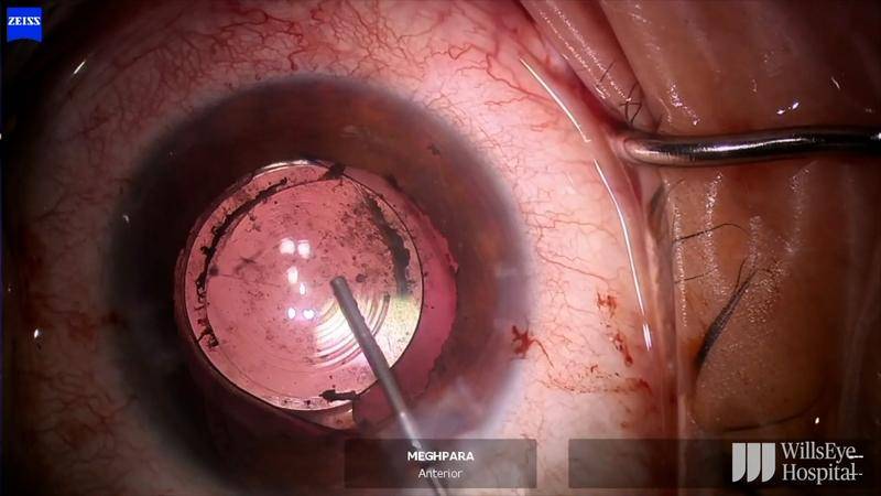 IOL Reposition in Setting of Extensive Synechiae thumbnail