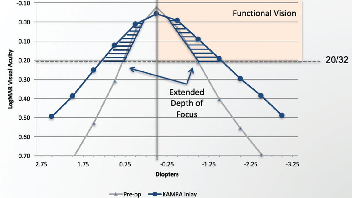 Myopia Why Refraction Matters