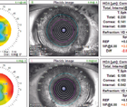 Cataracts and Russian Style Radial Keratotomy