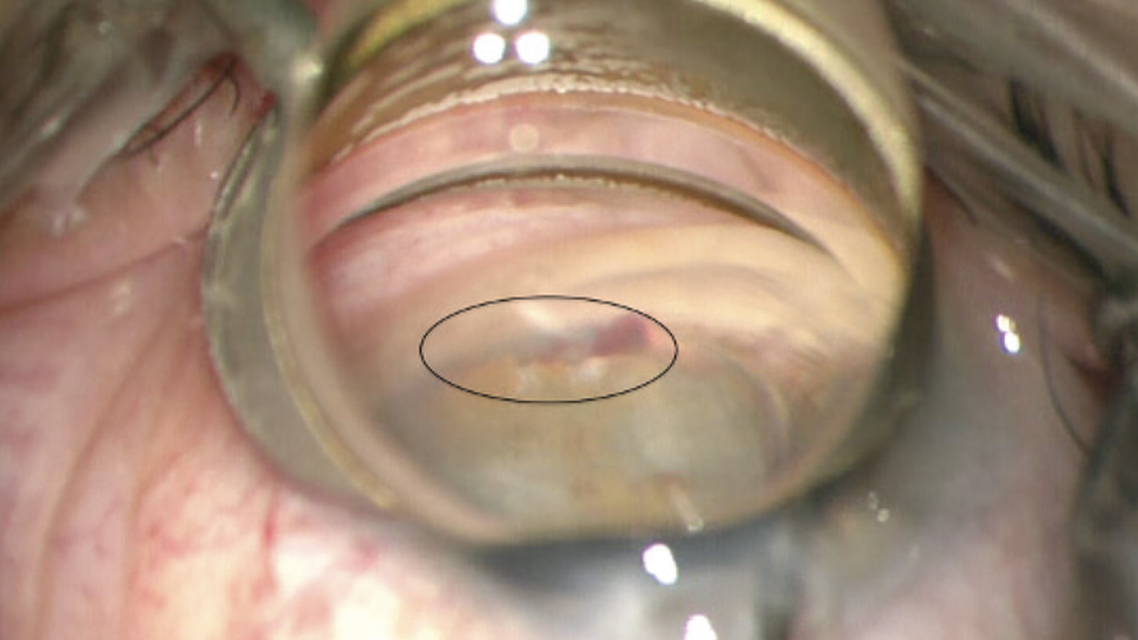 The Benefits of OMNI in Pseudophakic Patients