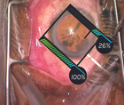 Clear Corneal Incisions