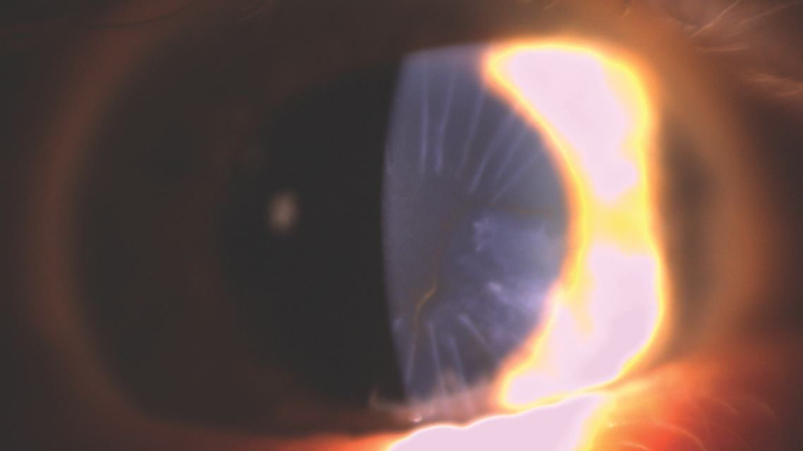 A Patient With Dry AMD Desires Improved Vision