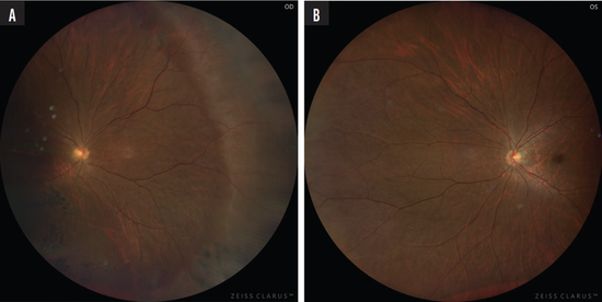 Cataract Surgery in Eyes With Retinal Pathology