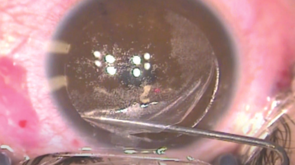 Management of a Flap Hinge Tear