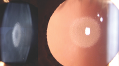 Nuclear Cataracts in a Young Adult