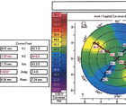 Cataract and Glaucoma After Penetrating Keratoplasty
