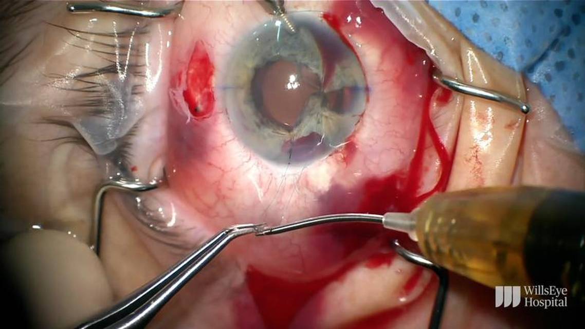 Yamane Technique and Iris Repair in Case of Trauma thumbnail