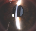 Excessive Vaulting of a Phakic IOL
