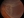 Figure 1. Rhegmatogenous retinal detachment, a potential long-term postoperative complication of RLE.