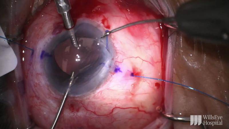 Reposition of a GoreTex Fixated IOL thumbnail