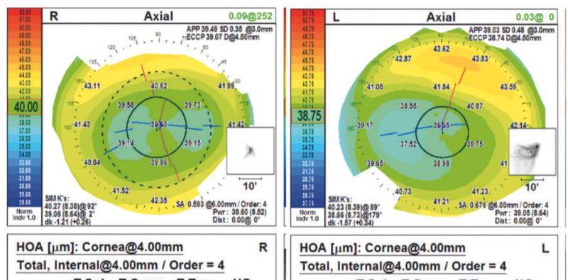 Is This the Perfect Candidate for Refractive Surgery