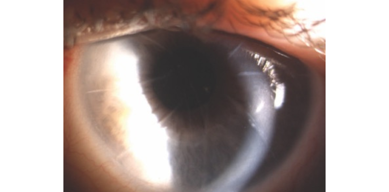 Refractive Treatment Options After Radial Keratotomy