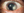 Figure 8. Typical interstitial keratitis in a patient with rosacea.