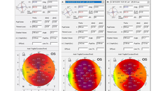 High Astigmatism and Amblyopia