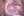 Figure 7. Flexible iris retractors were used to improve
access to the anterior capsule, and microscissors were
used to cut the edge of the capsulorhexis, allowing
enlargement of the CCC.
