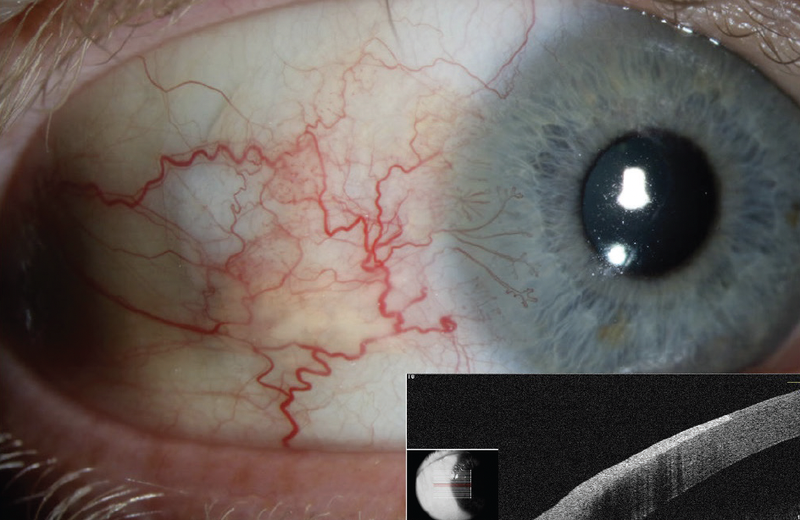 Ocular Surface Squamous Neoplasia in an Avid Sailor With Poor Compliance to Sun Protective Measures