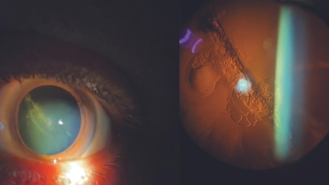 Traumatic Cataract Secondary to Needle Puncture for Intravitreal Injection