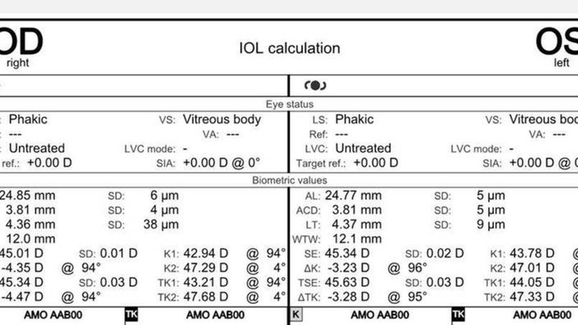 High Astigmatism With Underlying Ectasia