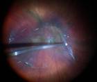 Complex Membrane Peel in Case of Combined Hamartoma thumbnail