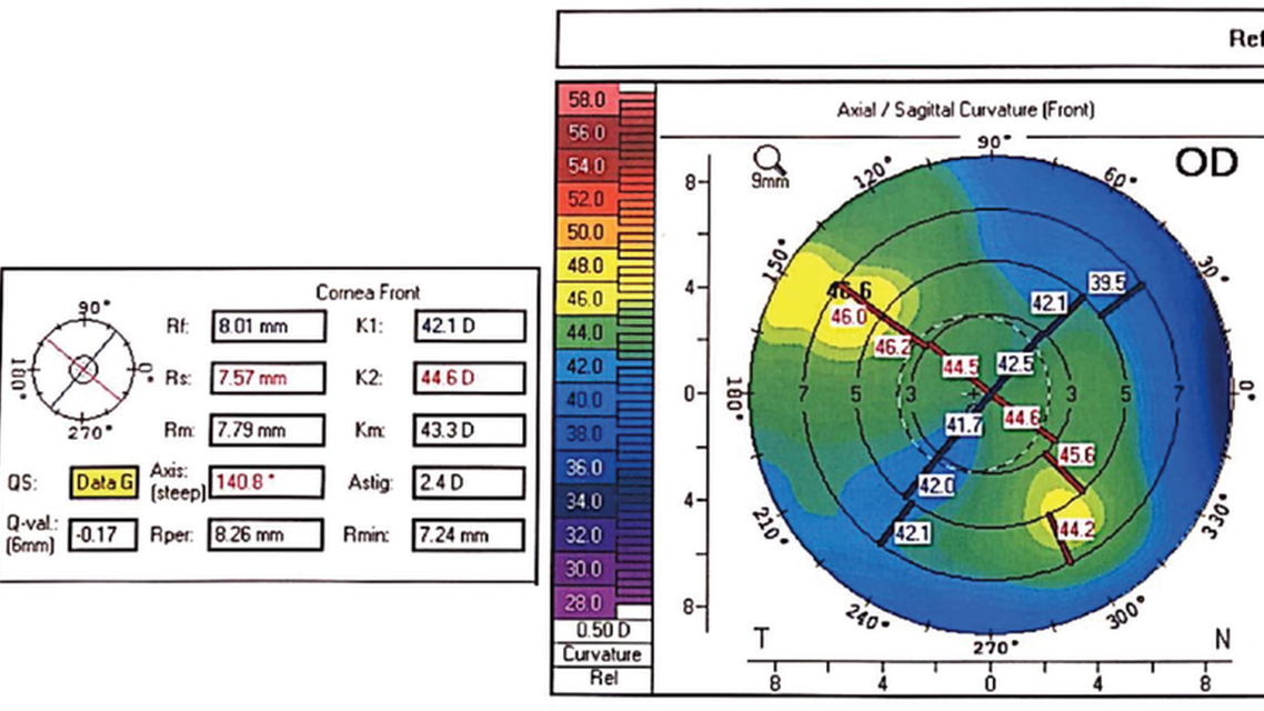 Cataract and Glaucoma After Penetrating Keratoplasty