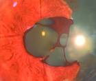 Traumatic Aniridia in a Patient With a History of Radial Keratotomy