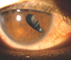 A Traumatically Dislocated but Perfectly Centered Multifocal IOL