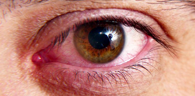 Treating Dry Eye Associated With Meibomian Gland Dysfunction