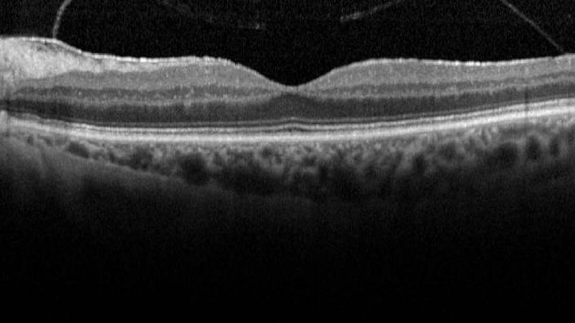 Evaluating the Retina Before Cataract Surgery