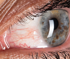 Targeting Inflammation in Dry Eye Disease