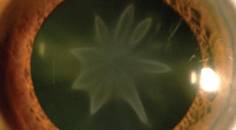 Star Shaped Cataract