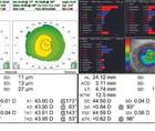 Cataract Surgery After LASIK