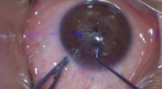How to Master Small Incision Lenticule Extraction