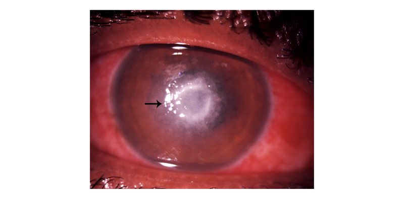 A Rare Case of Pythium Keratitis Masquerading as Fungal Keratitis
