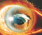 Late Spontaneous Dislocation of the IOLCapsular Bag Complex in a Patient With Retinitis Pigmentosa