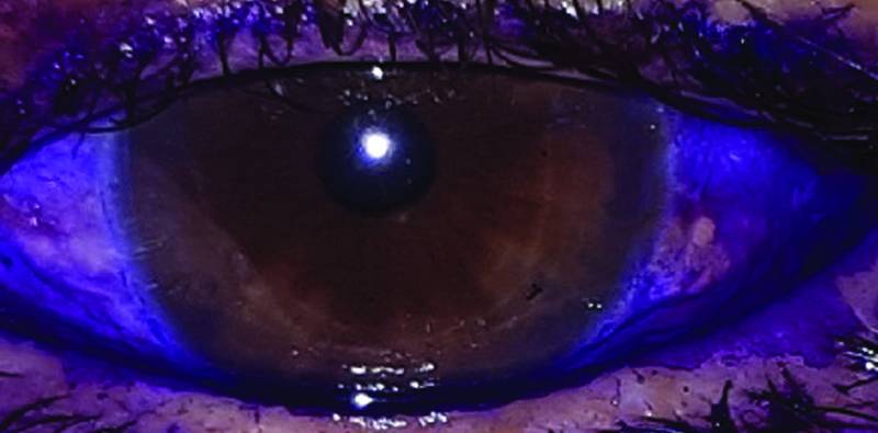 Dye Enhanced Laser Conjunctivoplasty for Conjunctivochalasis