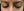 Figure 3. Grayish-blue hyperpigmentation of the periocular skin of the left eye.