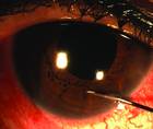 Leaky Anterior Chamber Paracentesis