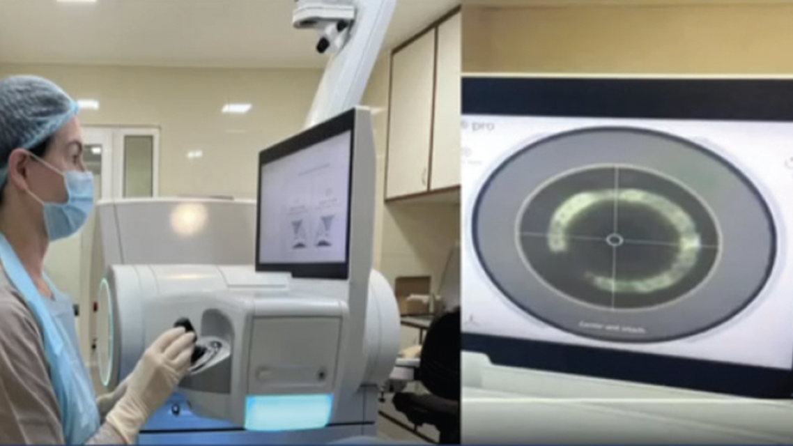 ZEISS VISUMAX 800 Redefining Refractive Surgery with Unmatched Speed and Comfort