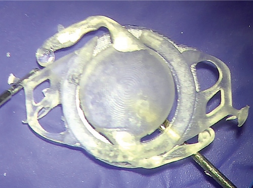 Iol Consignment Open Rack The Expanding Landscape of Secondary IOL Fixation