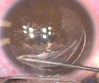 Management of a Flap Hinge Tear