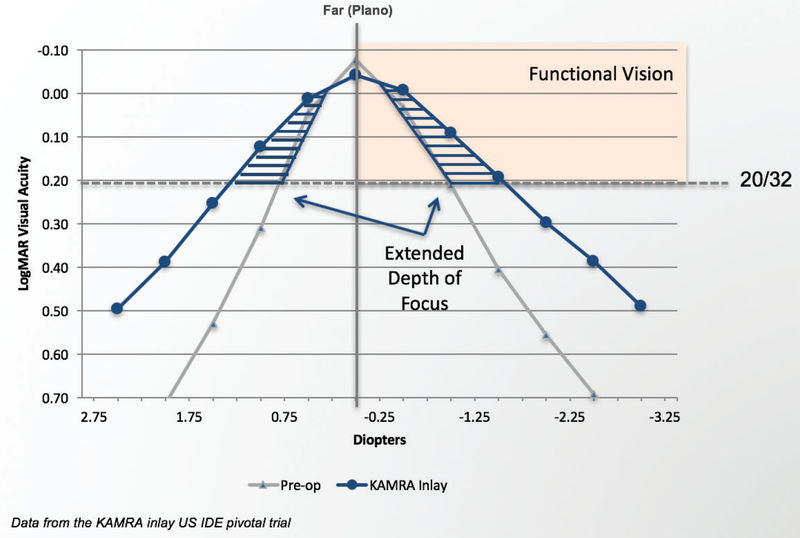 Myopia Why Refraction Matters