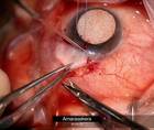 Choroidal Drainage and Repair of Bleb Leak thumbnail
