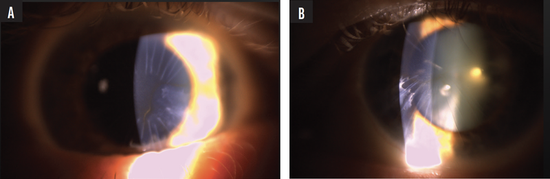 More Than 20 Radial Keratotomy Incisions