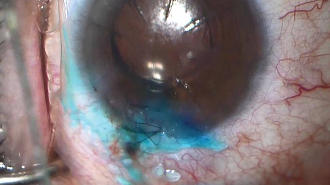 Wound Sealing and Stromal Hydration
