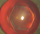 Poor Vision After Hexagonal Keratotomy